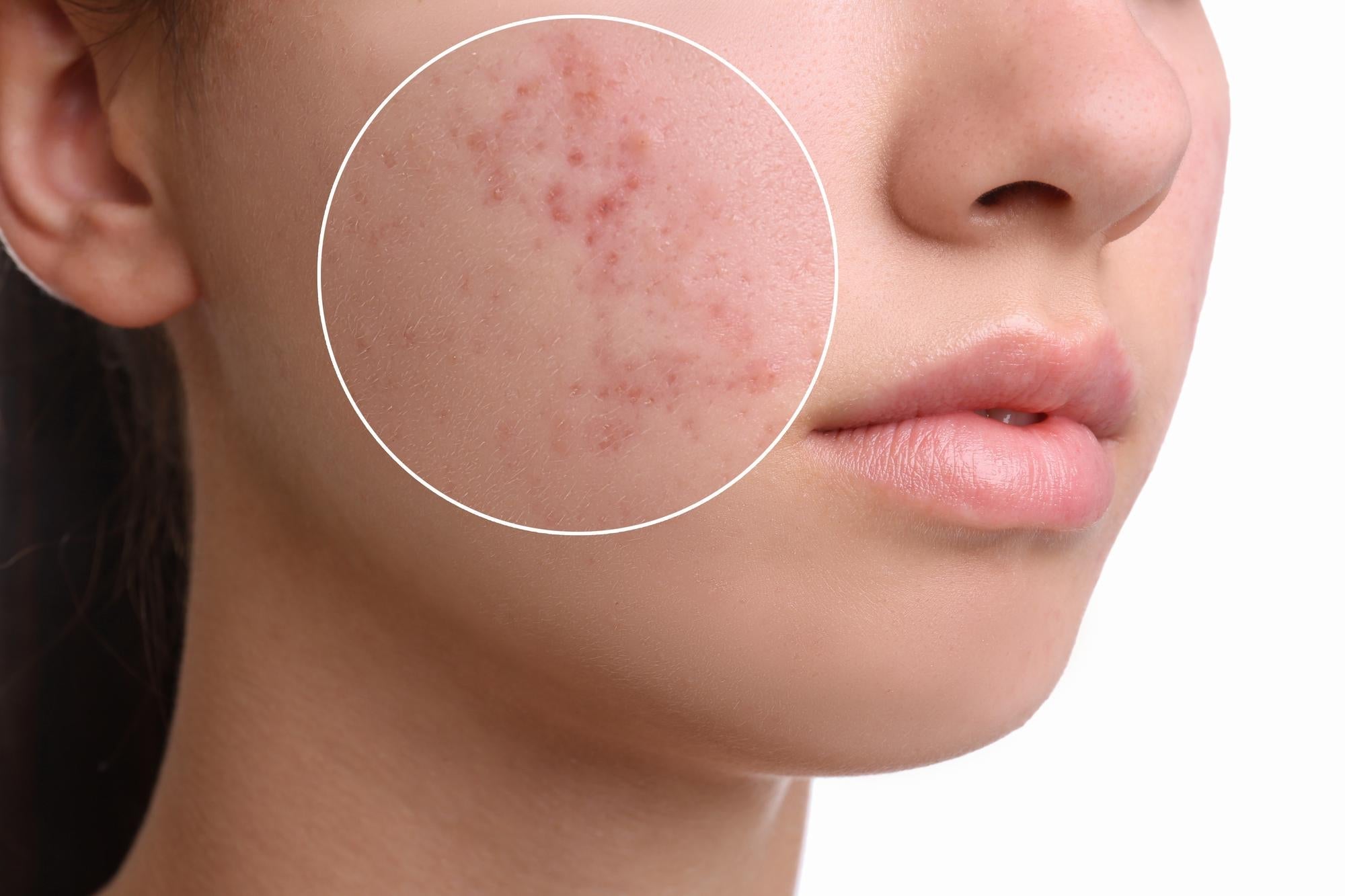 5 Common Mistakes That Make Your Acne-Prone Skin Worse